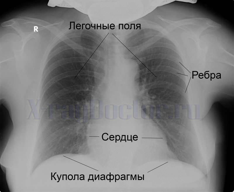 Снимок рентген лёгких человека 