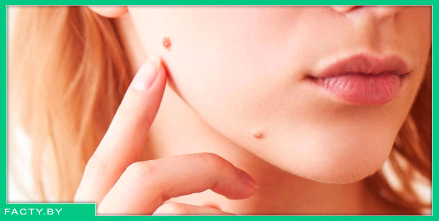 В течении месяца необходимо защищать кожу от ультрафиолетовых лучей для предотвращения пигментации и повреждения тканей в области удаления невуса.